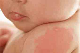 causes of birthmark