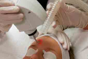 laser treatment of birthmark