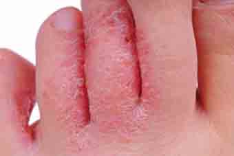 What are some of the effective skin fungal infection creams on the market?