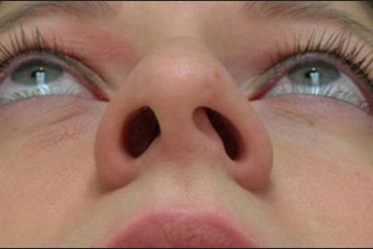 best candidate for nose reshaping