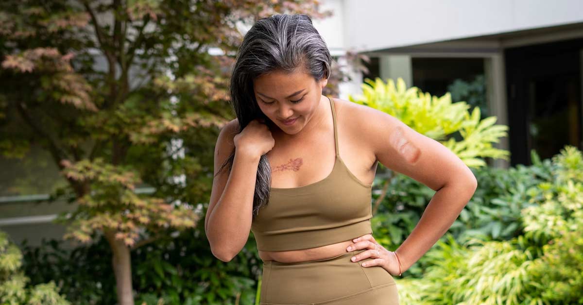 How to heal the keloid - thenationalskincentre-drnavin-taneja