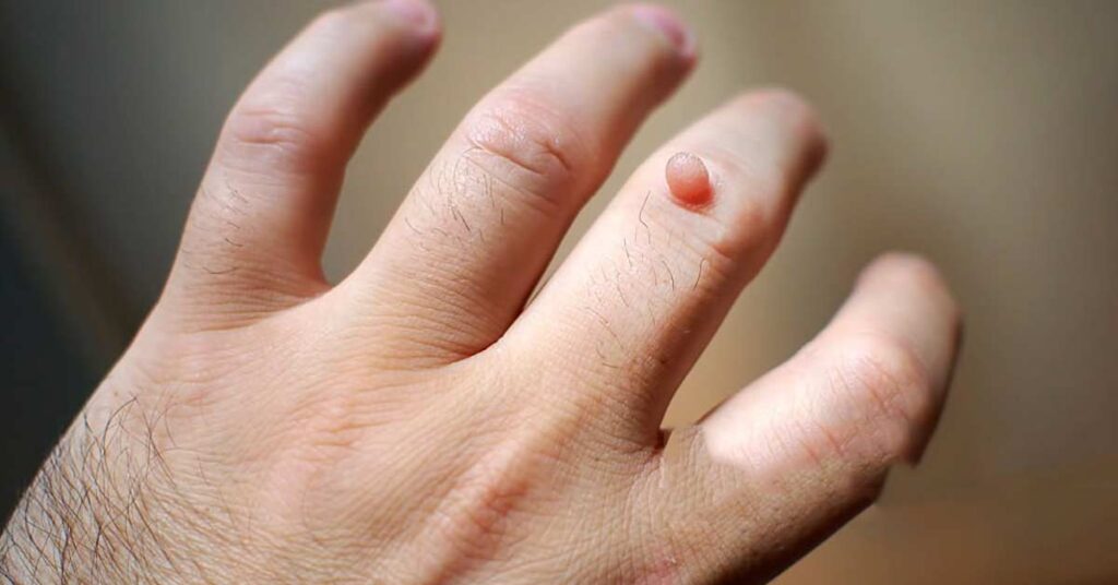 warts how to identify:causes