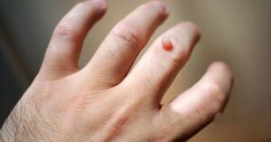 warts how to identify:causes