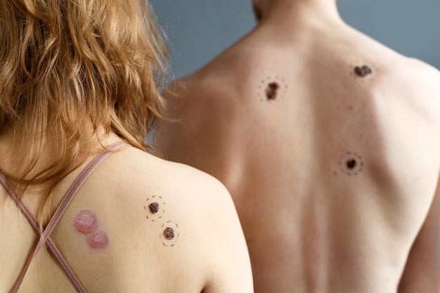 identify-different-type-of-warts