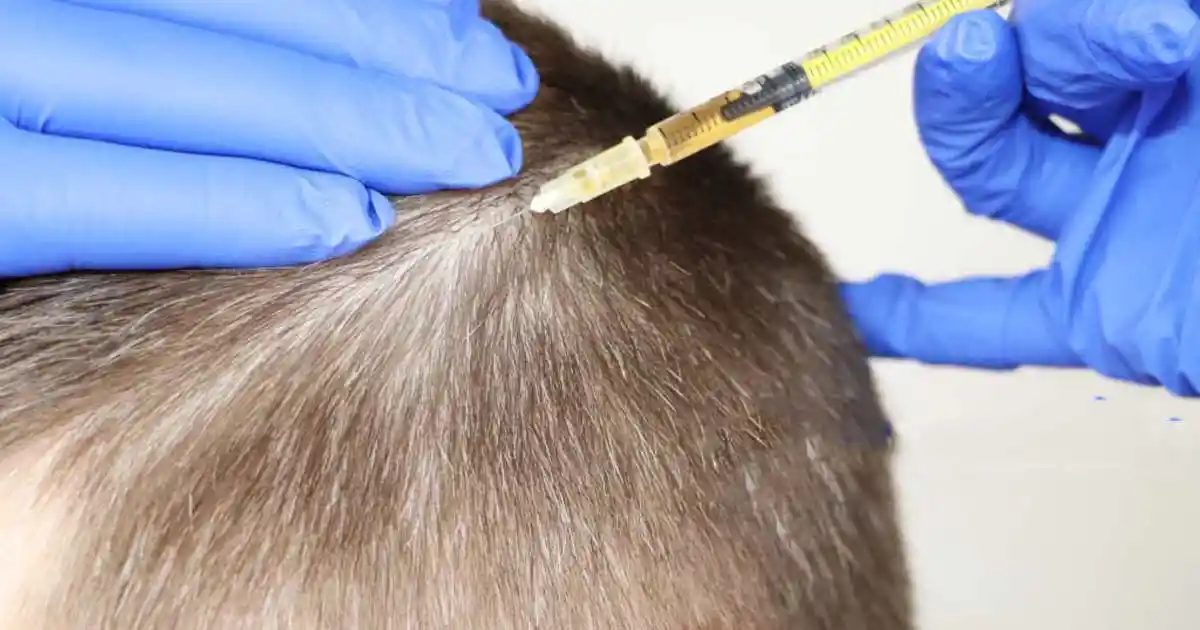 prp hair regrowth