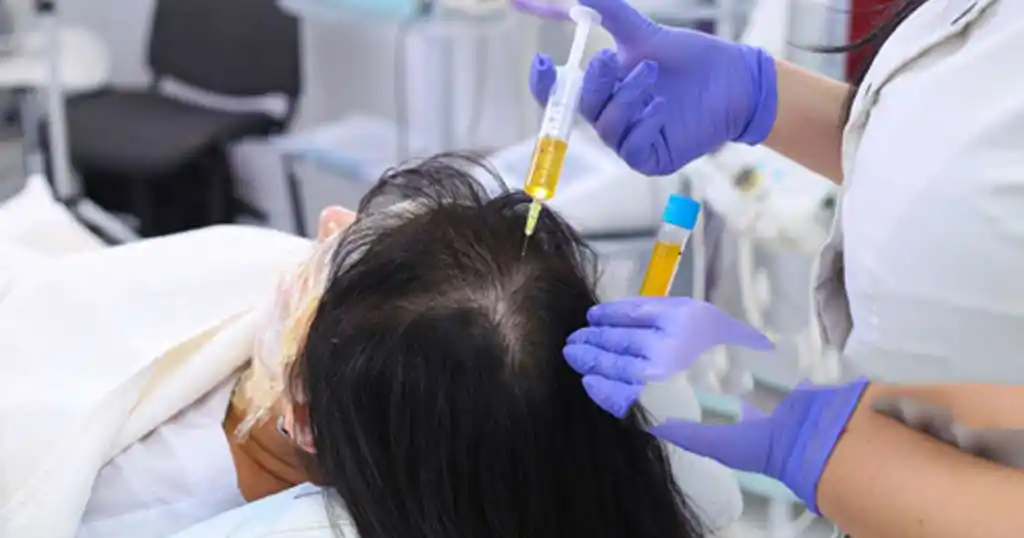 prp-for-hairloss-treatment-in-delhi