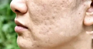 acne scar treatment in delhi by dr navin taneja dermatologist at south delhi clinic