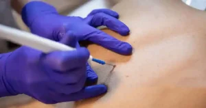 laser warts removal treatment in delhi