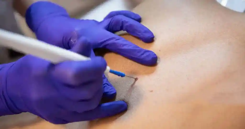 Surgical Skin Wart Removal: What to Expect