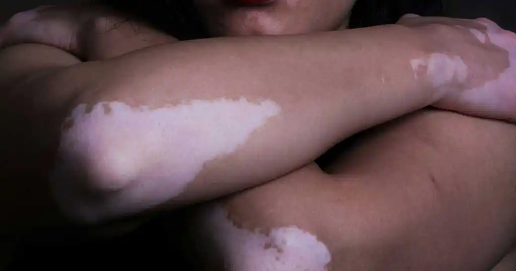 doctor for vitiligo treatment in delhi