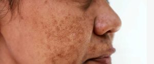 pigmentation-melasma-treatment