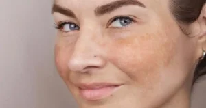 pigmentation removal treatment