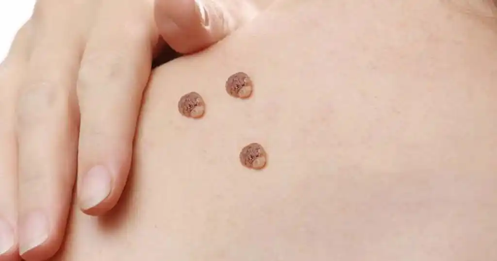 warts causes