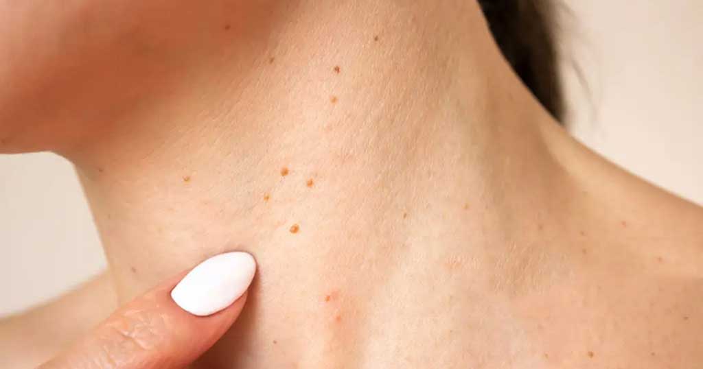 How to remove warts