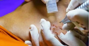non-surgical-keloid-treatment