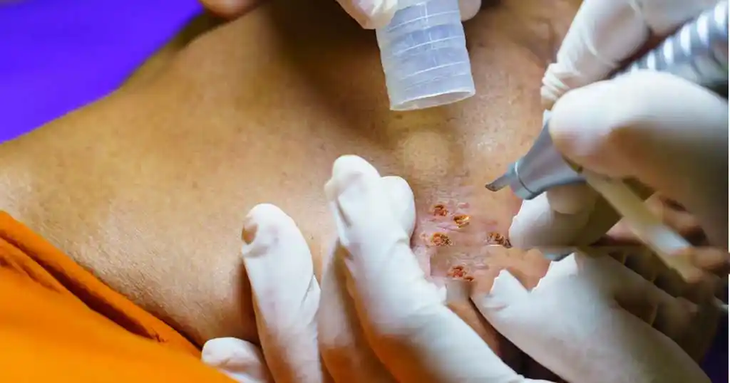 non-surgical-keloid-treatment