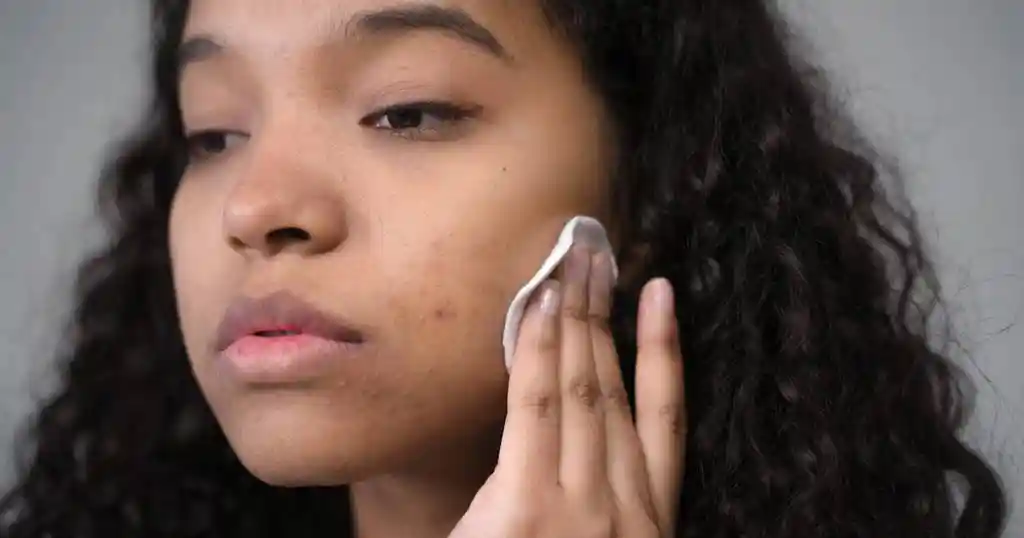 hormonal acne causes