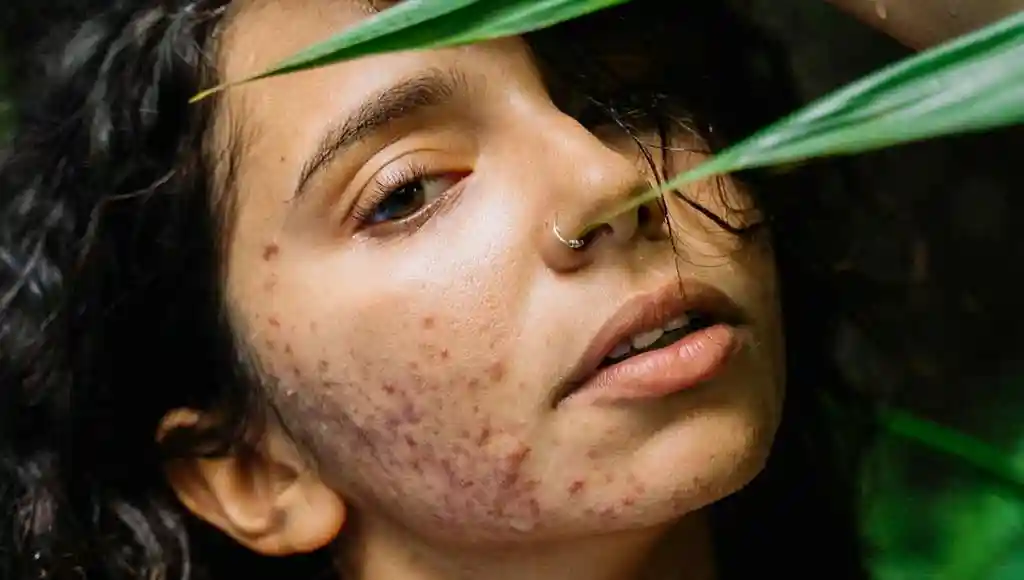 How to Control Oily Skin and Acne in Summer