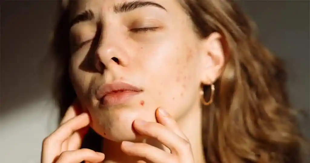 how to care and treatment of acne in summer session
