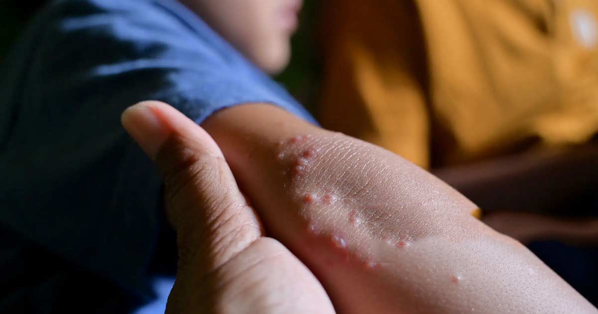 what is viral warts