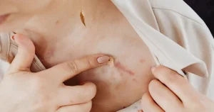 chest and shoulder keloid