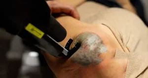 how laser tattoo removal works and remove the tattoo