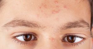 teen acne treatment by dr navin taneja