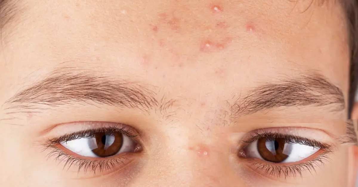 teen acne treatment by dr navin taneja
