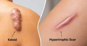 keloid-vs-hypertrophic-scar