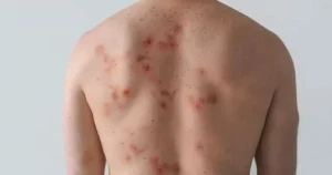 how do get back coming back warts