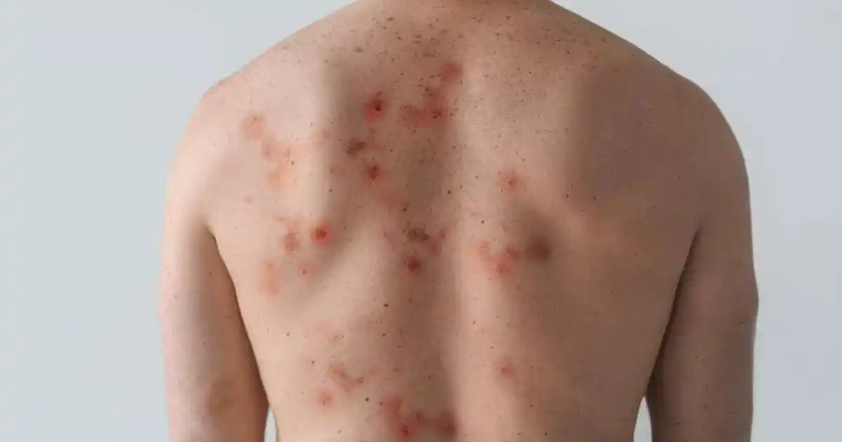 how do get back coming back warts