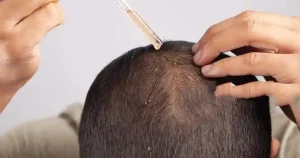 alopecia areata