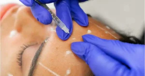Botox for face forehead line by dermatologit dr navin taneja