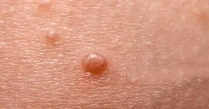 Molluscum Contagiosum