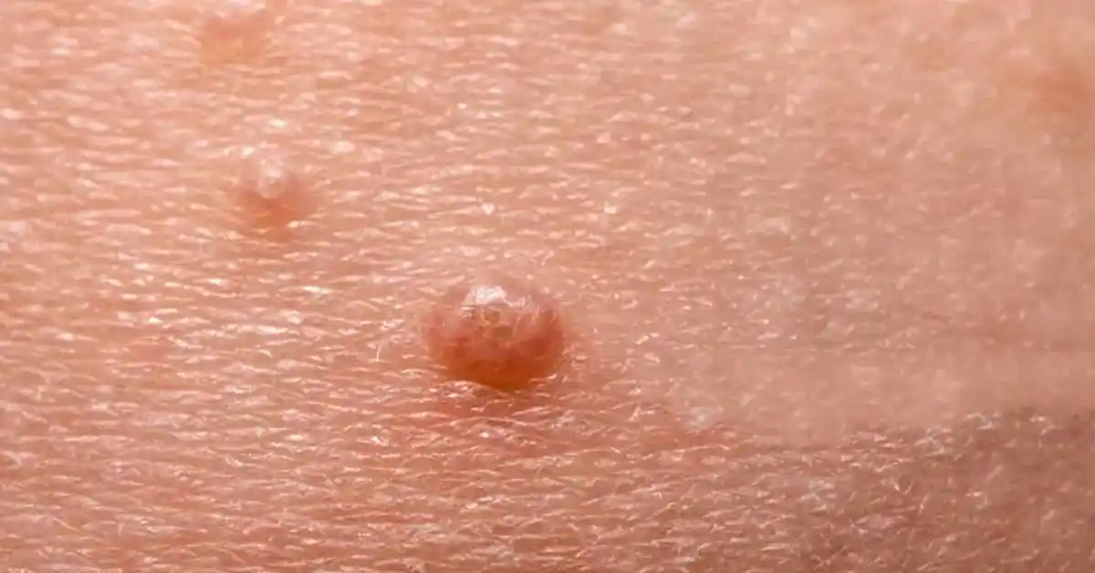 Molluscum Contagiosum