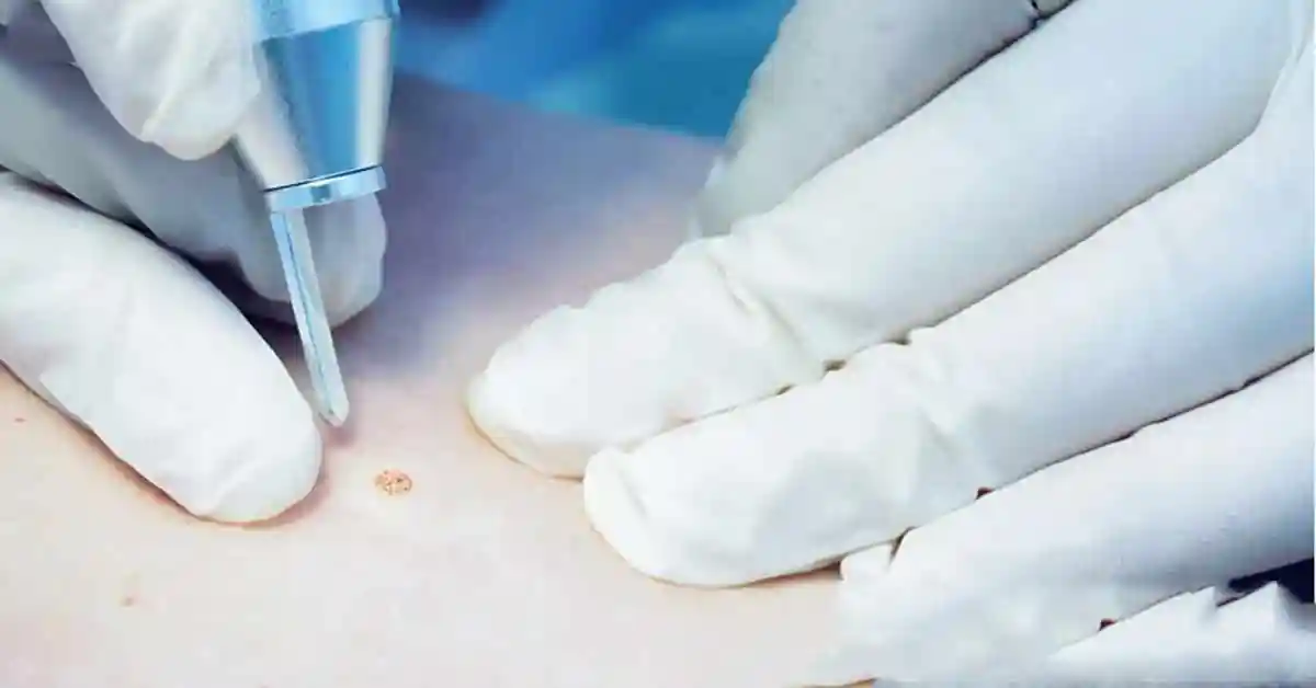 Laser vs. Cryotherapy vs. Electrocautery for Warts