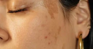 How to Remove Pigmentation from Face Permanently