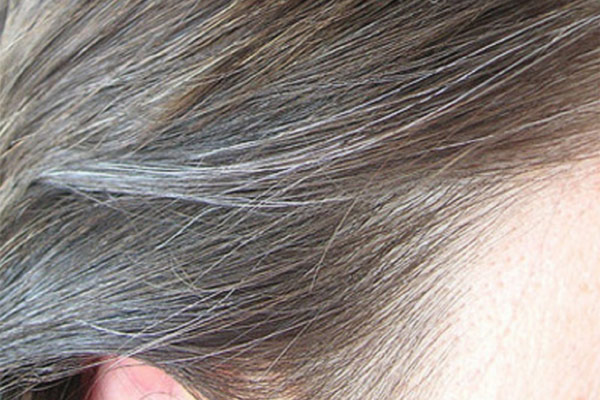 Premature greying white hair treatment clinic in delhi, India