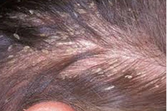 scalp disease treatment in delhi. India