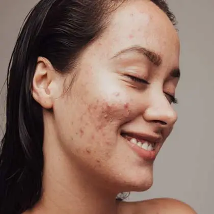 Acne Specialist Doctor in South Delhi