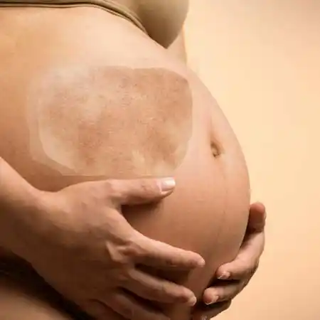 Birthmark Specialist Doctor in Delhi