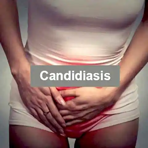 candidiasis treatment Specialist Doctor in Delhi