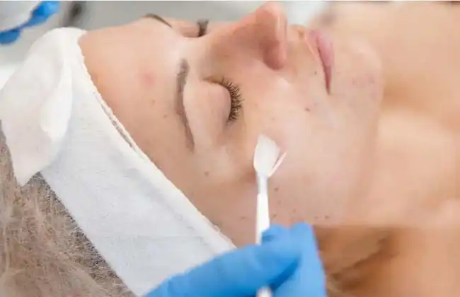 chemical peel treatment for skin whitening in delhi near me South Delhi