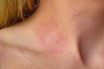 what are symptoms of skin allergy