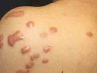 Keloid Scars Types