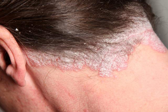 psoriasis treatment