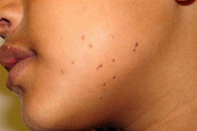 Warts treatment with garlic, Wart treatment with garlic,, Skin warts on face and neck
