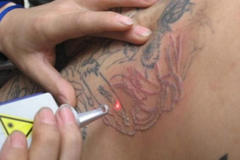 non surgical tattoo removal surgery