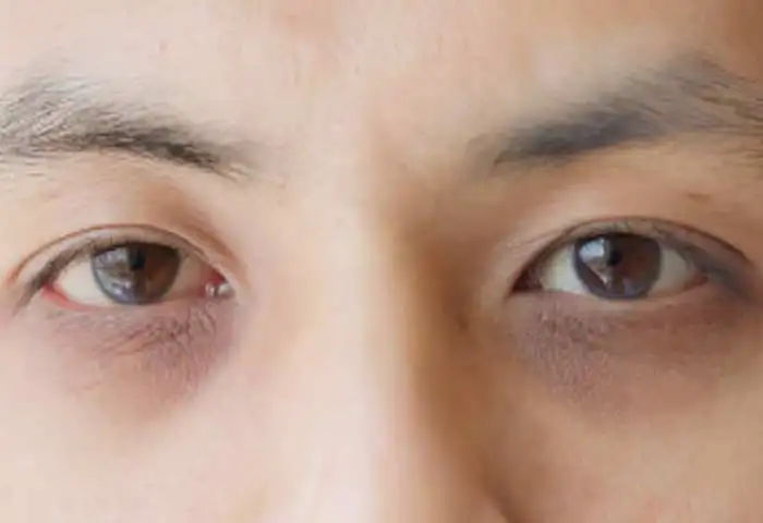 Dark circles Specialist Doctor in Delhi