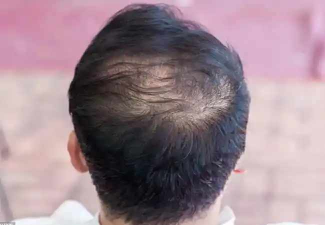 hair thining treatment in Delhi